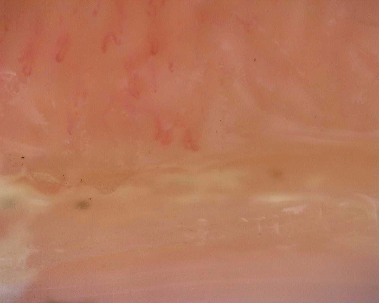Nailfold capillaroscopy: right middle finger, field a. Follow-up study. Juvenile Dermatomyositis anti-NXP2 with Capillaroscopic Improvement.