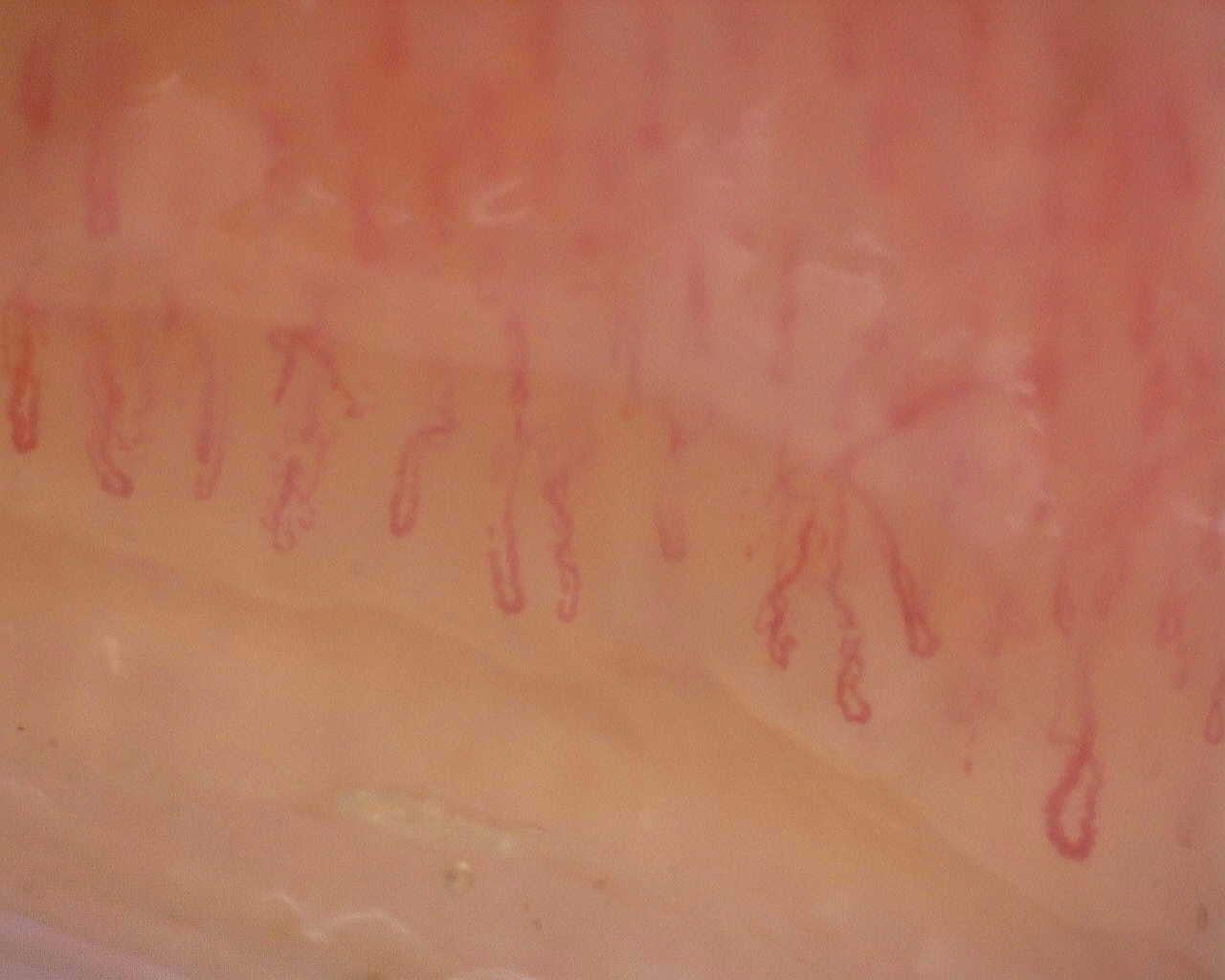 Nailfold capillaroscopy: right index finger, field a. Follow-up study. Juvenile Dermatomyositis anti-NXP2 with Capillaroscopic Improvement.