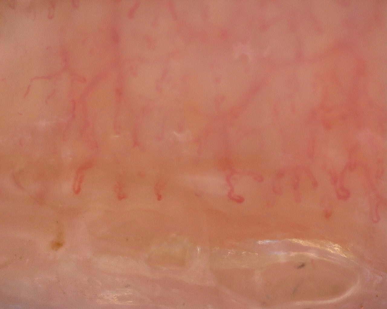Nailfold capillaroscopy: right little finger, field a. Follow-up study. Juvenile Dermatomyositis anti-NXP2 with Capillaroscopic Improvement.