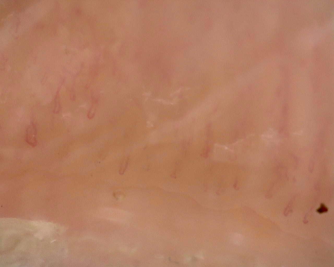 Nailfold capillaroscopy: left middle finger, field a. Follow-up study. Juvenile Dermatomyositis anti-NXP2 with Capillaroscopic Improvement.