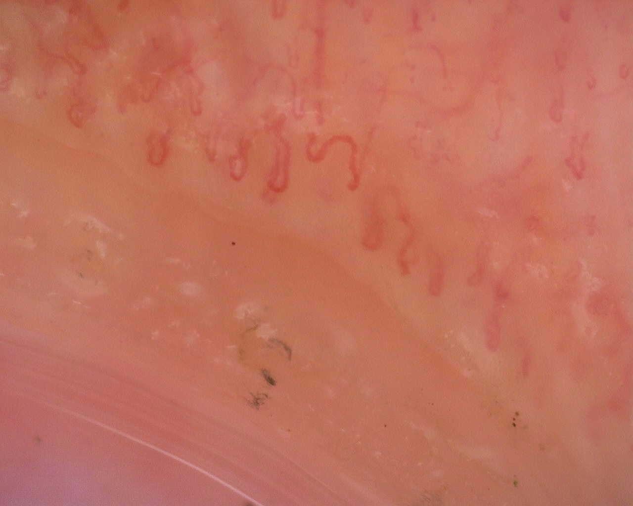 Nailfold capillaroscopy: left ring finger, field a. Follow-up study. Juvenile Dermatomyositis anti-NXP2 with Capillaroscopic Improvement.