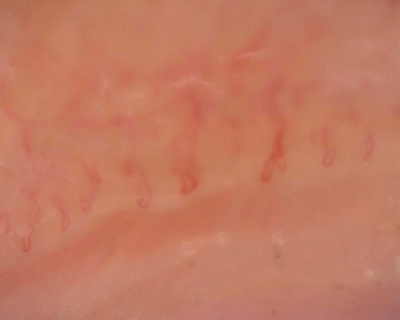Nailfold capillaroscopy: left little finger, field a. Follow-up study. Juvenile Dermatomyositis anti-NXP2 with Capillaroscopic Improvement.