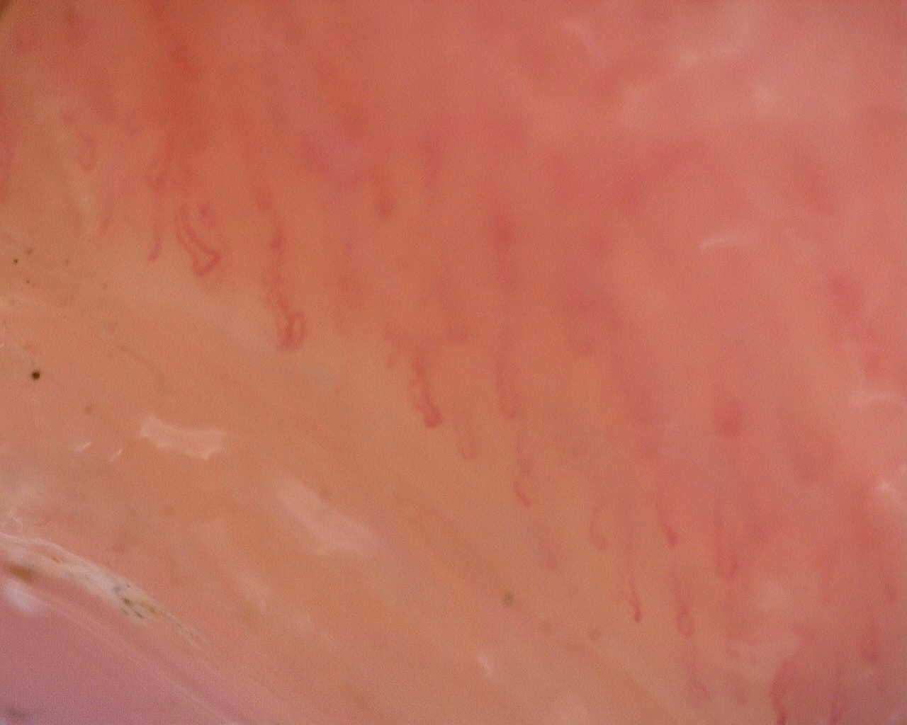 Nailfold capillaroscopy: right middle finger, field a. Follow-up study. Juvenile Dermatomyositis anti-NXP2 with Capillaroscopic Improvement.