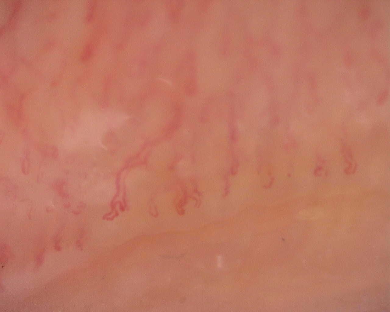 Nailfold capillaroscopy: right ring finger, field a. Follow-up study. Juvenile Dermatomyositis anti-NXP2 with Capillaroscopic Improvement.