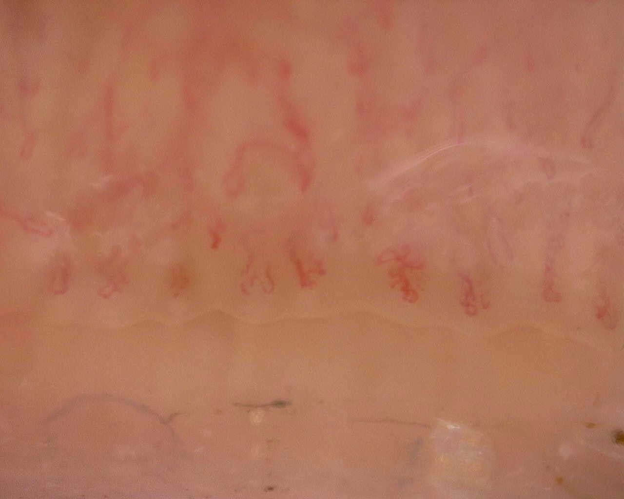 Nailfold capillaroscopy: right ring finger, field a. Follow-up study. Juvenile Dermatomyositis anti-NXP2 with Capillaroscopic Improvement.