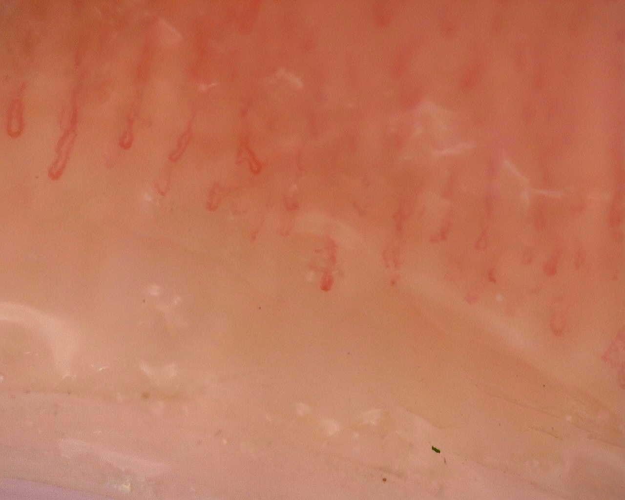 Nailfold capillaroscopy: left index finger, field a. Follow-up study. Juvenile Dermatomyositis anti-NXP2 with Capillaroscopic Improvement.