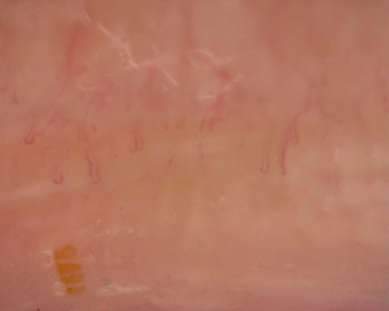 Nailfold capillaroscopy: left little finger, field a. Follow-up study. Juvenile Dermatomyositis anti-NXP2 with Capillaroscopic Improvement.
