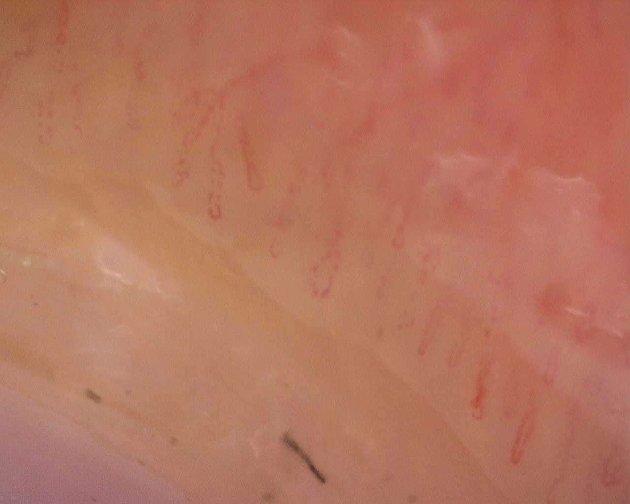 Nailfold capillaroscopy: right index finger, field a. Follow-up study. Juvenile Dermatomyositis anti-NXP2 with Capillaroscopic Improvement.