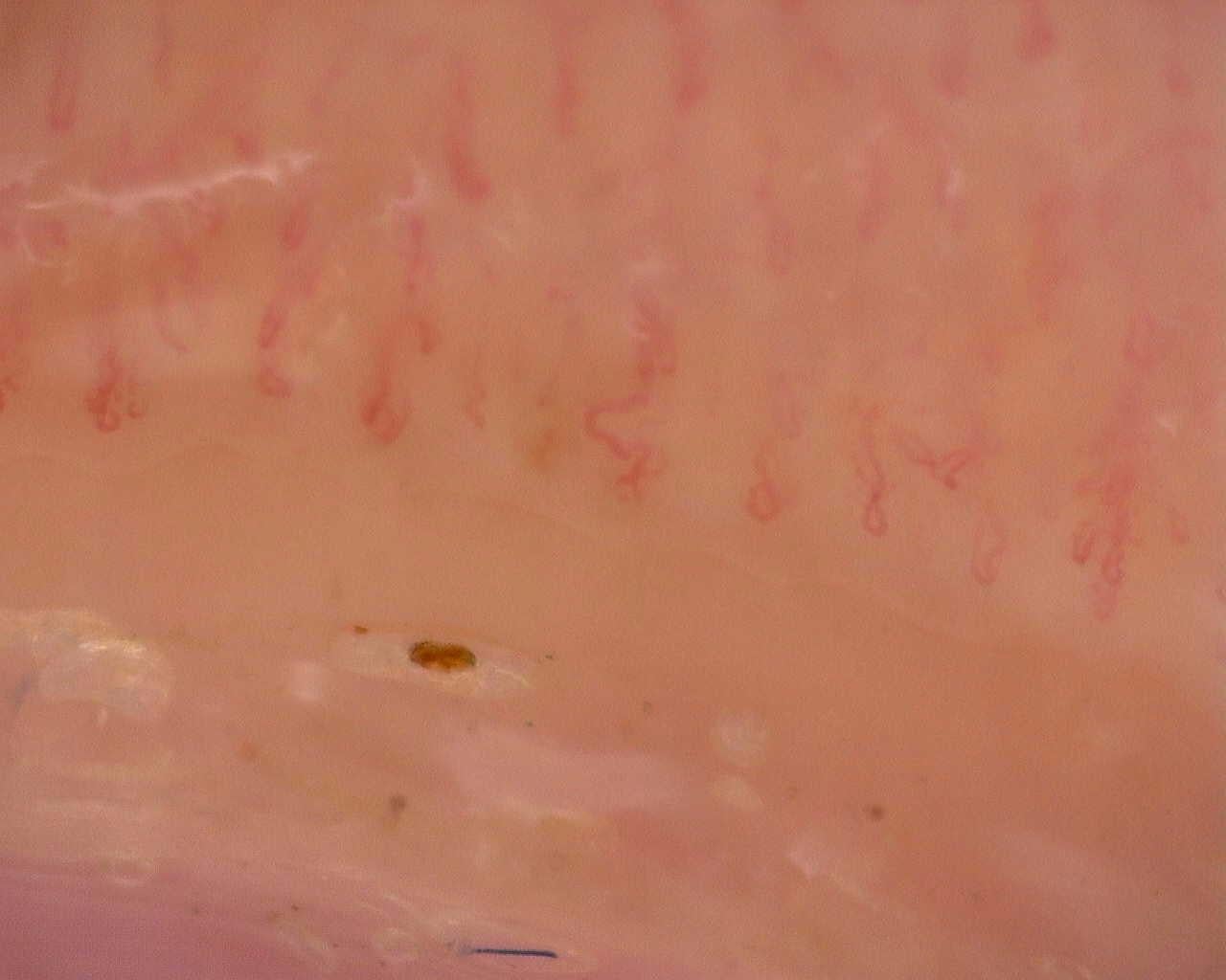 Nailfold capillaroscopy: right ring finger, field a. Follow-up study. Juvenile Dermatomyositis anti-NXP2 with Capillaroscopic Improvement.