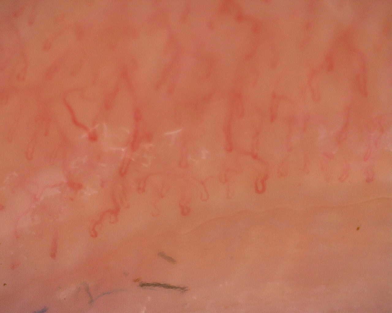 Nailfold capillaroscopy: left ring finger, field a. Follow-up study. Juvenile Dermatomyositis anti-NXP2 with Capillaroscopic Improvement.
