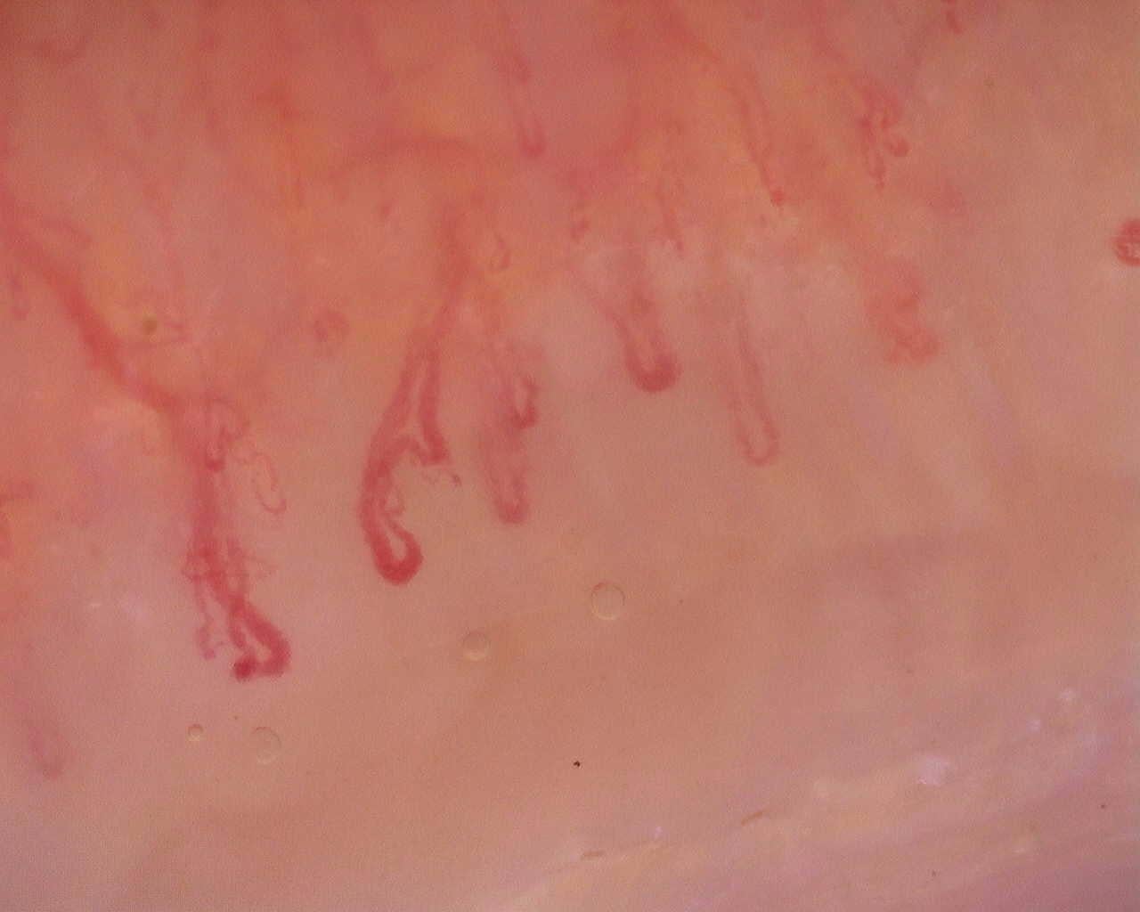 Nailfold capillaroscopy: right ring finger, field a. Initial study. Juvenile Dermatomyositis anti-NXP2 with Capillaroscopic Improvement.