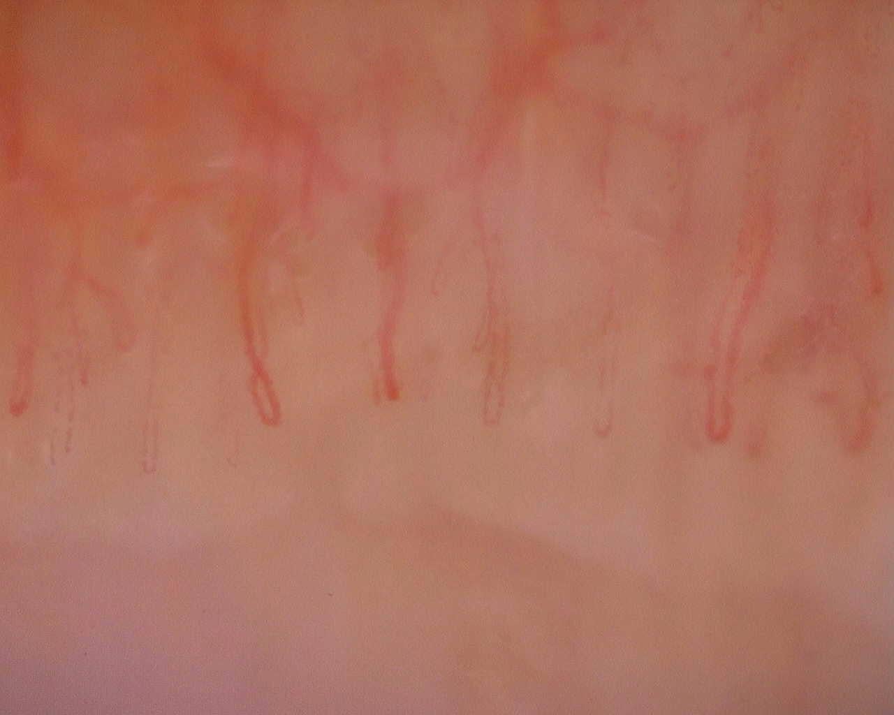 Nailfold capillaroscopy: left middle finger, field a. Initial study. Juvenile Dermatomyositis anti-NXP2 with Capillaroscopic Improvement.