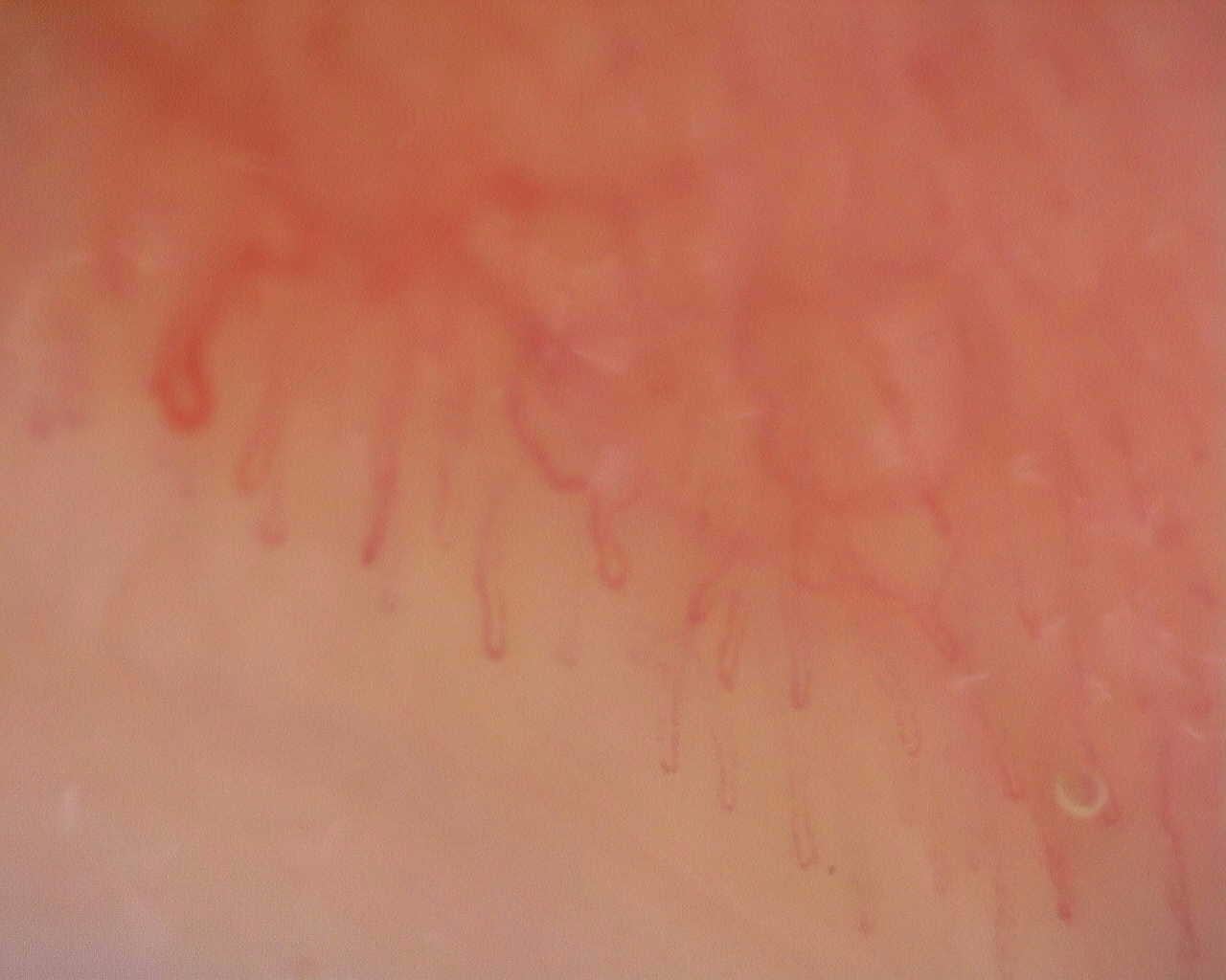 Nailfold capillaroscopy: right ring finger, field a. Initial study. Juvenile Dermatomyositis anti-NXP2 with Capillaroscopic Improvement.