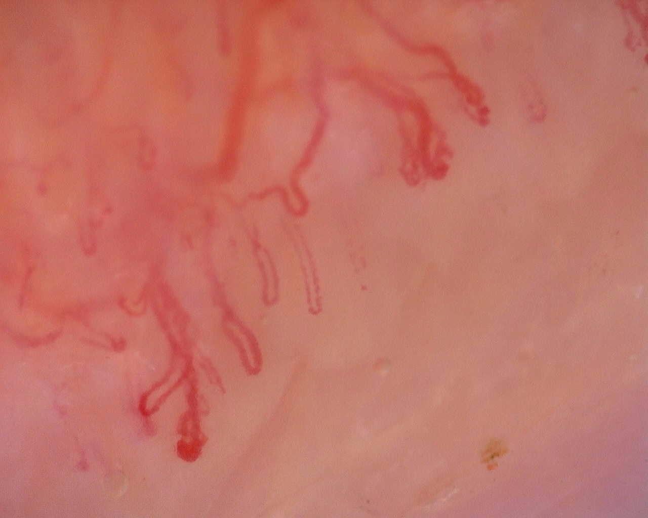 Nailfold capillaroscopy: right ring finger, field a. Initial study. Juvenile Dermatomyositis anti-NXP2 with Capillaroscopic Improvement.