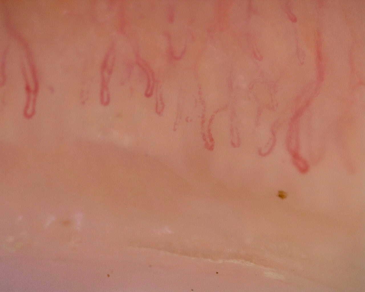 Nailfold capillaroscopy: right little finger, field a. Initial study. Juvenile Dermatomyositis anti-NXP2 with Capillaroscopic Improvement.