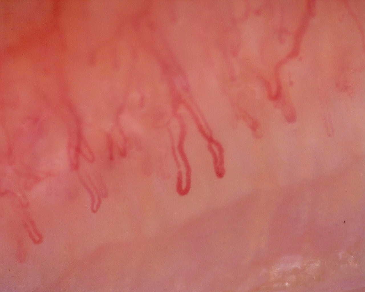 Nailfold capillaroscopy: right little finger, field a. Initial study. Juvenile Dermatomyositis anti-NXP2 with Capillaroscopic Improvement.