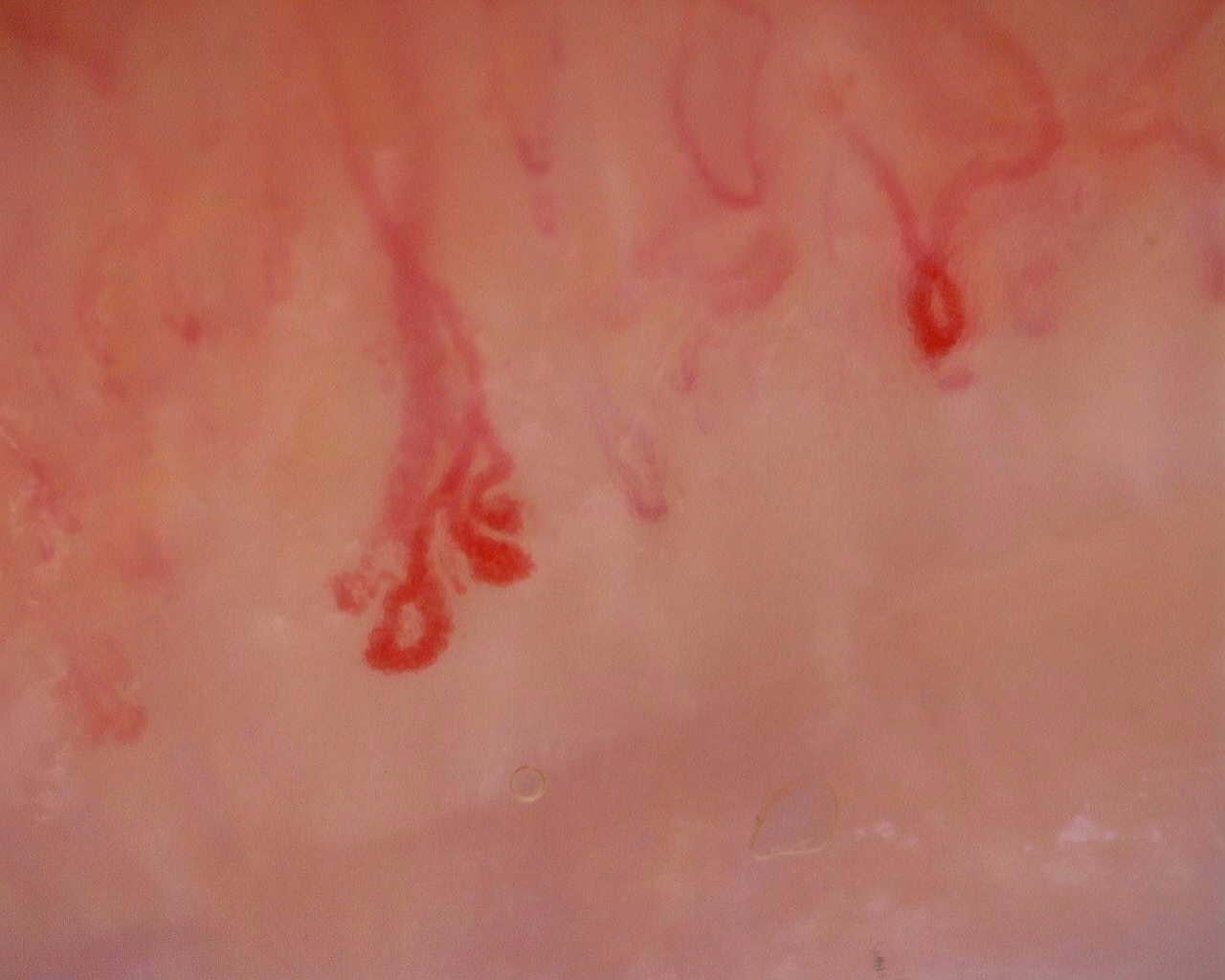 Nailfold capillaroscopy: right ring finger, field a. Initial study. Juvenile Dermatomyositis anti-NXP2 with Capillaroscopic Improvement.