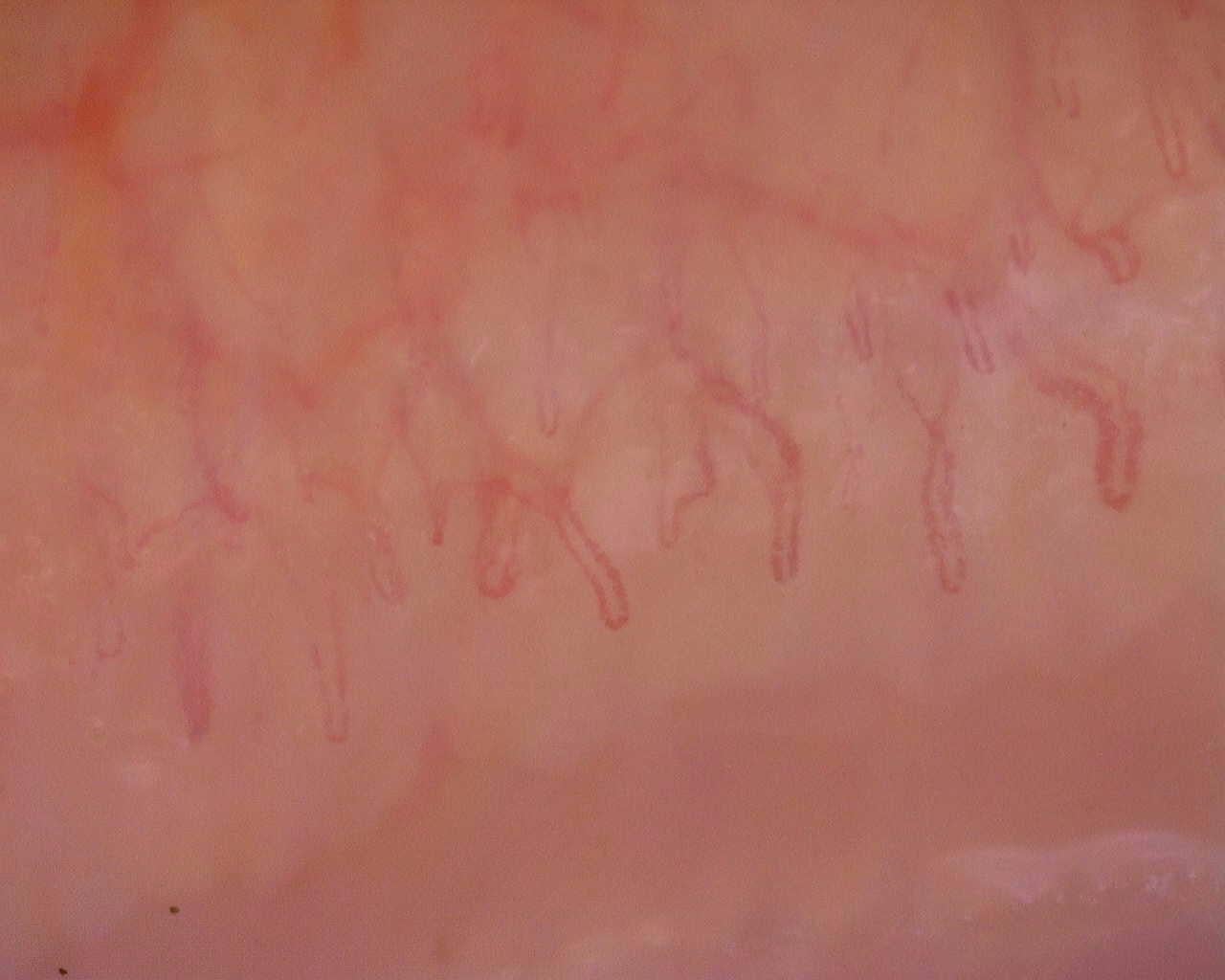 Nailfold capillaroscopy: left ring finger, field a. Initial study. Juvenile Dermatomyositis anti-NXP2 with Capillaroscopic Improvement.