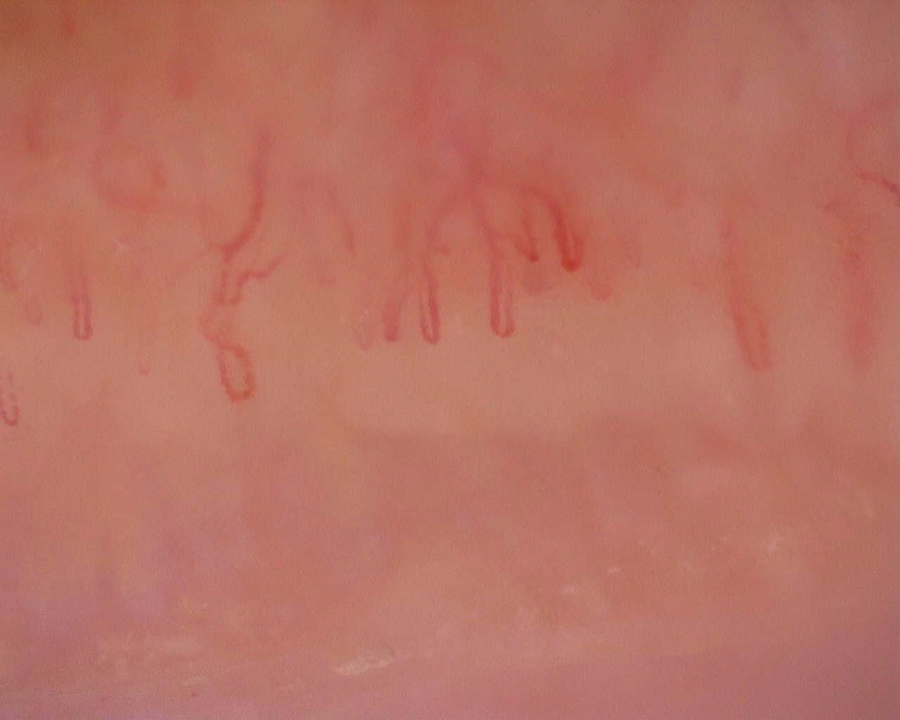 Nailfold capillaroscopy: left little finger, field a. Initial study. Juvenile Dermatomyositis anti-NXP2 with Capillaroscopic Improvement.