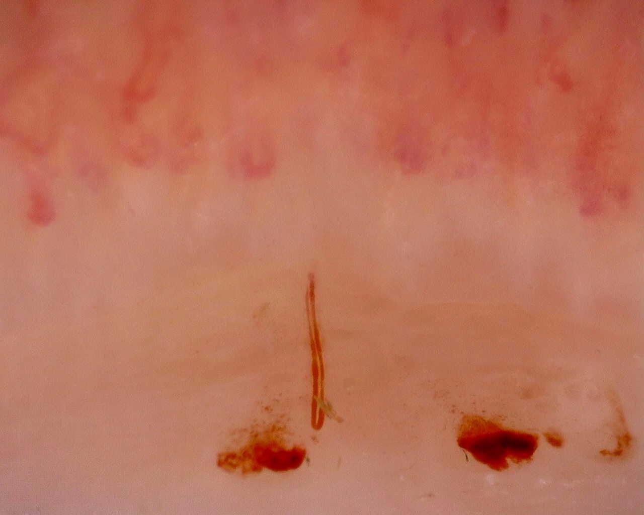 Nailfold capillaroscopy: right ring finger, field a. Initial study. Juvenile Dermatomyositis anti-NXP2 with Capillaroscopic Improvement.