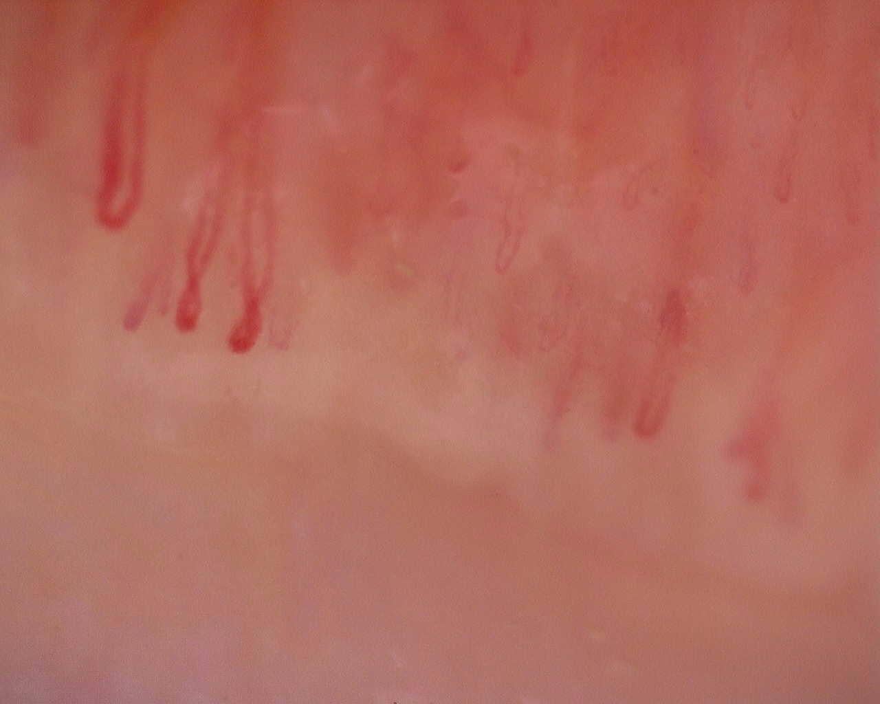 Nailfold capillaroscopy: left index finger, field a. Initial study. Juvenile Dermatomyositis anti-NXP2 with Capillaroscopic Improvement.