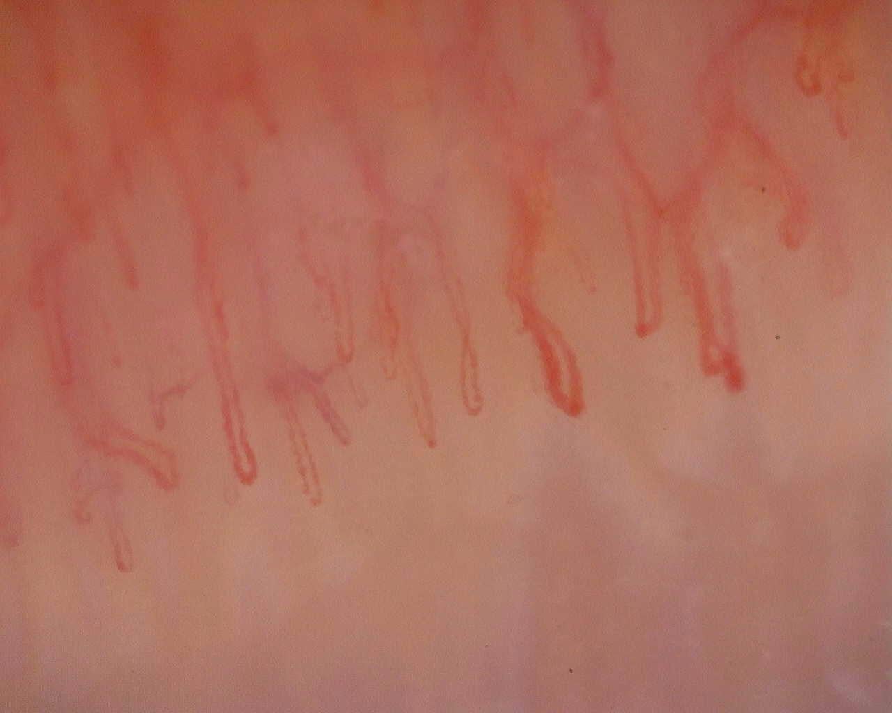 Nailfold capillaroscopy: right middle finger, field a. Initial study. Juvenile Dermatomyositis anti-NXP2 with Capillaroscopic Improvement.