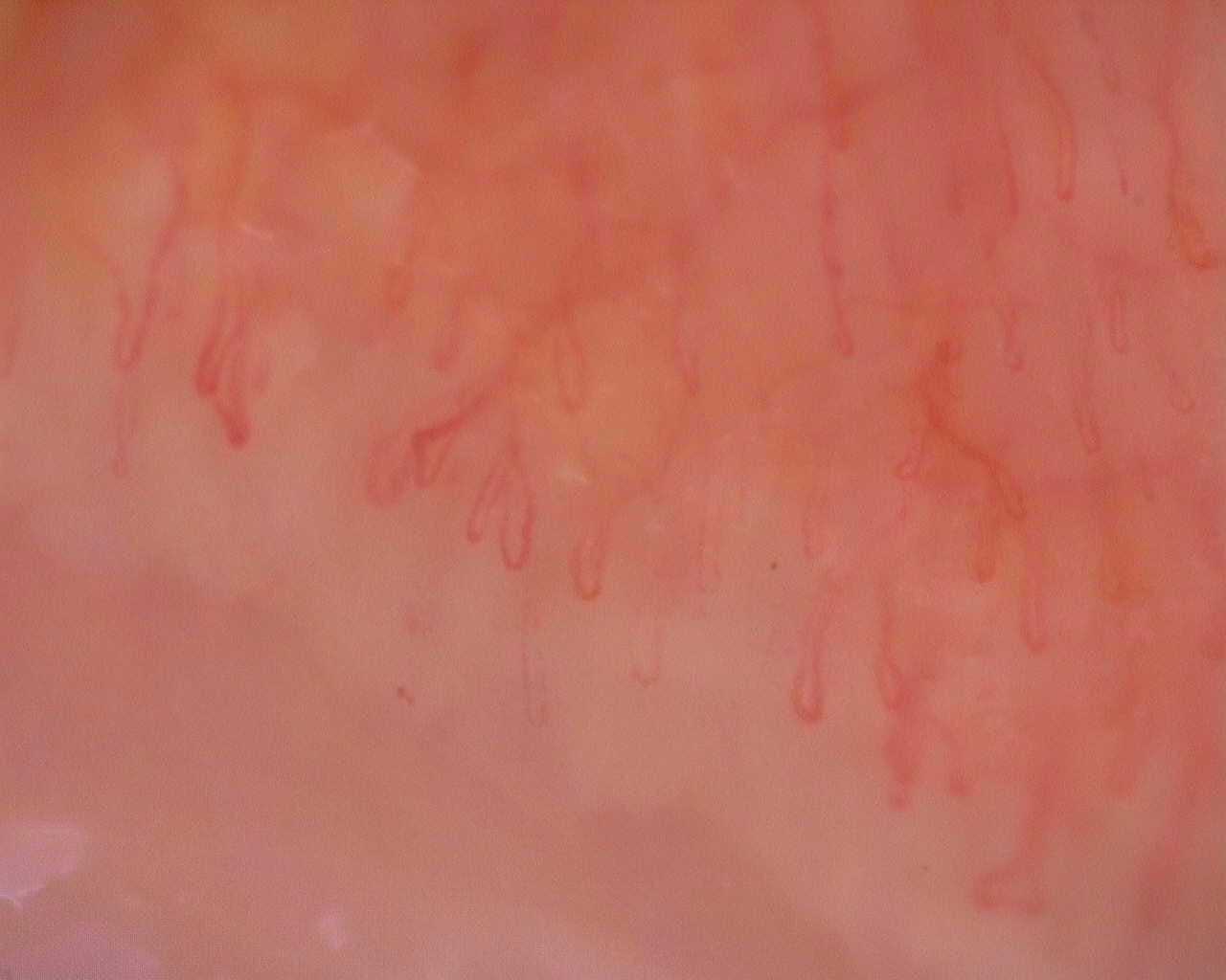 Nailfold capillaroscopy: left middle finger, field a. Initial study. Juvenile Dermatomyositis anti-NXP2 with Capillaroscopic Improvement.