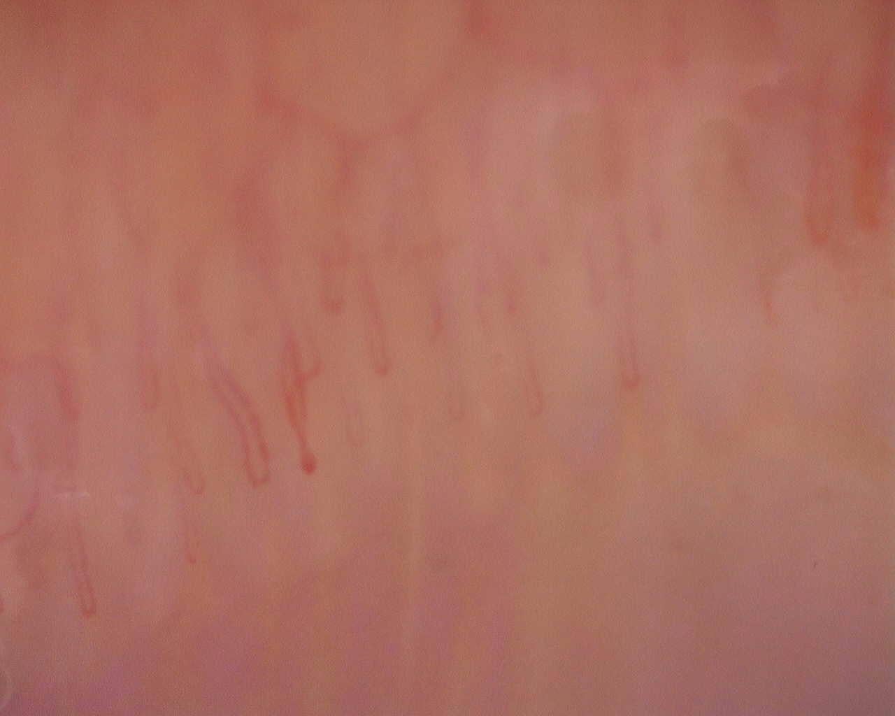Nailfold capillaroscopy: left middle finger, field a. Initial study. Juvenile Dermatomyositis anti-NXP2 with Capillaroscopic Improvement.