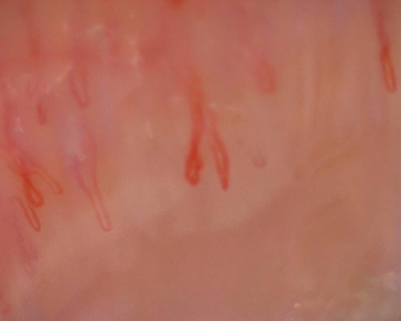 Nailfold capillaroscopy: right index finger, field a. Initial study. Juvenile Dermatomyositis anti-NXP2 with Capillaroscopic Improvement.