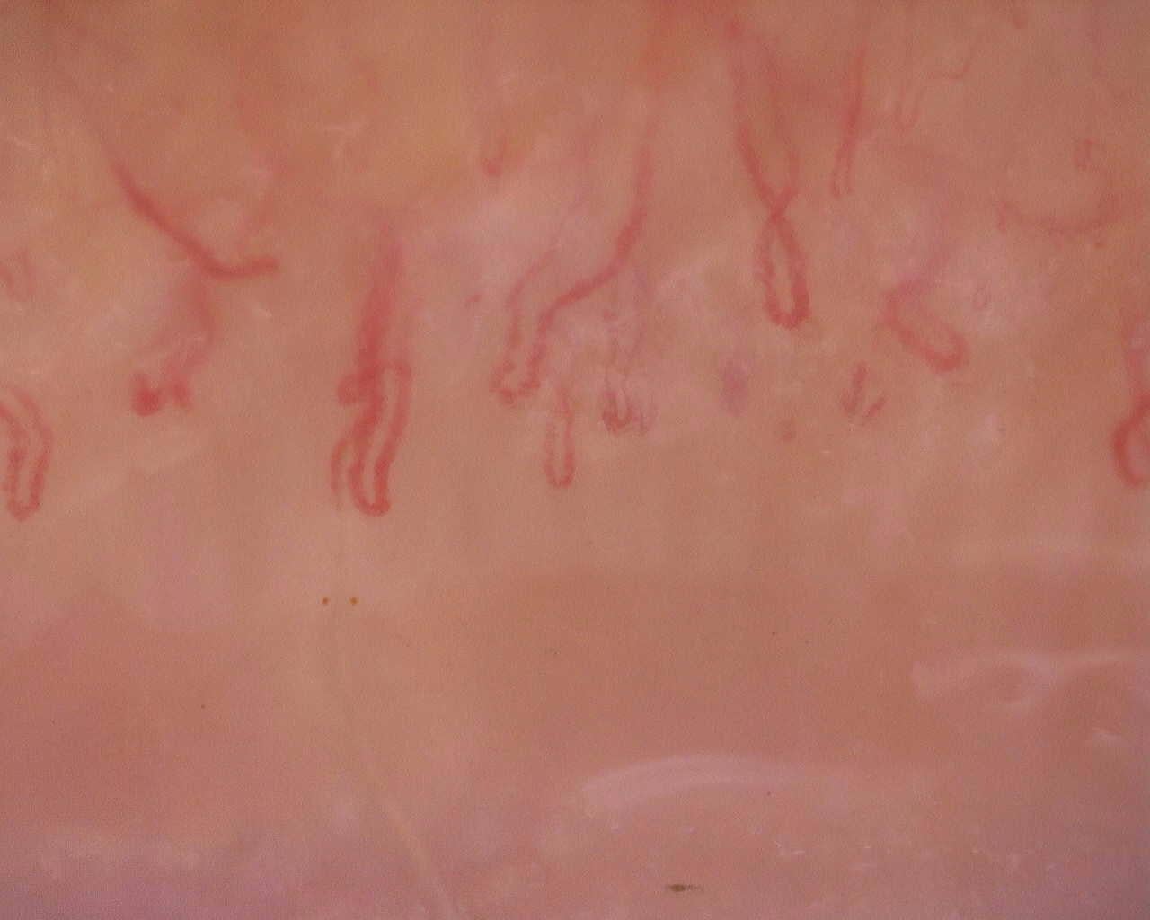 Nailfold capillaroscopy: left ring finger, field a. Initial study. Juvenile Dermatomyositis anti-NXP2 with Capillaroscopic Improvement.