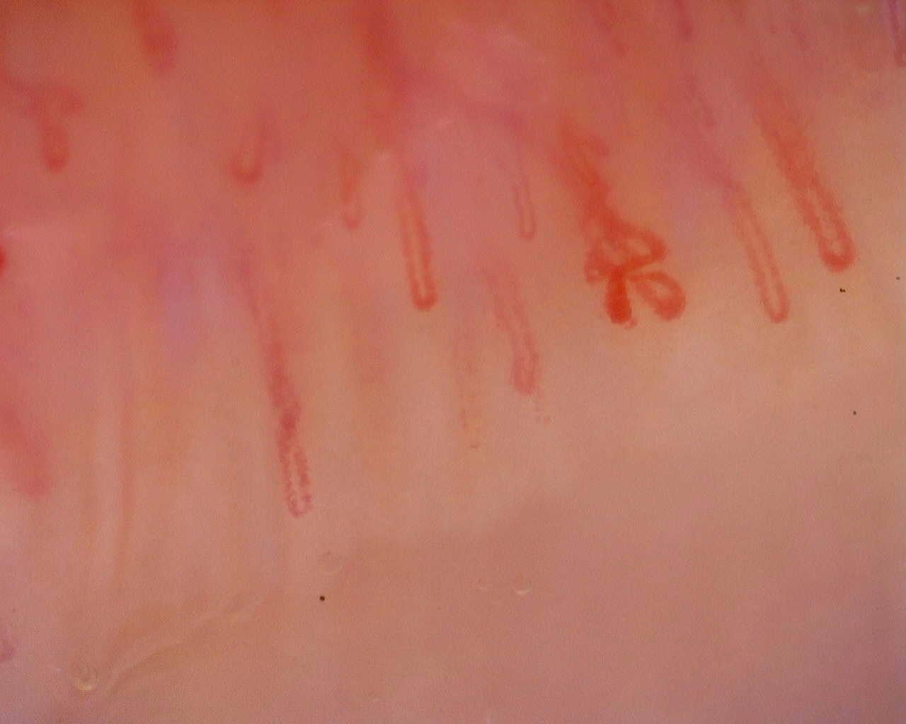 Nailfold capillaroscopy: right index finger, field a. Initial study. Juvenile Dermatomyositis anti-NXP2 with Capillaroscopic Improvement.