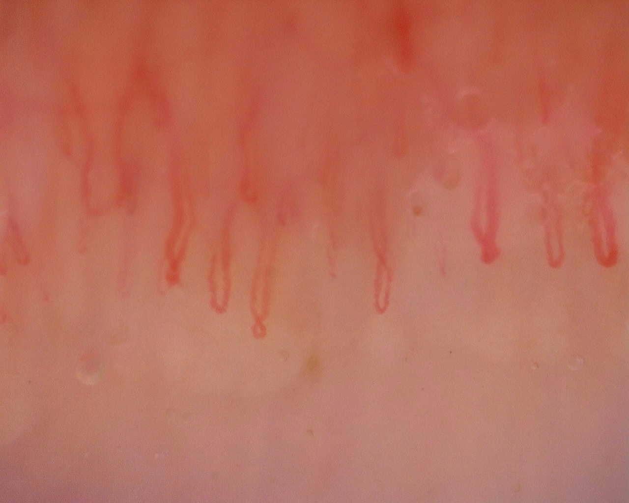 Nailfold capillaroscopy: left index finger, field a. Initial study. Juvenile Dermatomyositis anti-NXP2 with Capillaroscopic Improvement.
