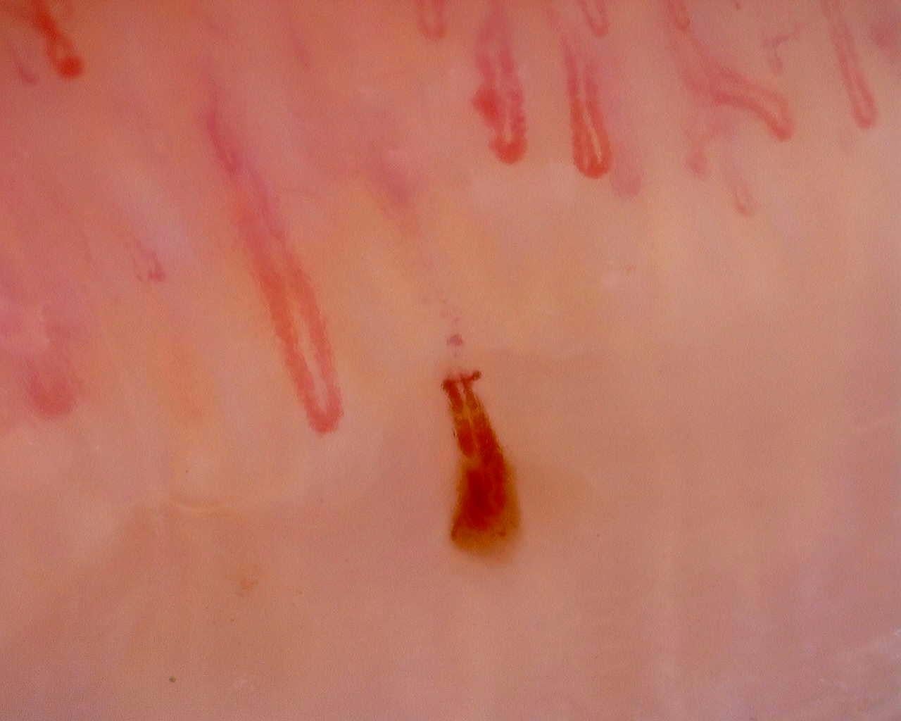 Nailfold capillaroscopy: right middle finger, field a. Initial study. Juvenile Dermatomyositis anti-NXP2 with Capillaroscopic Improvement.