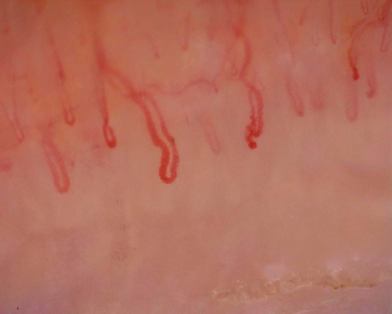 Nailfold capillaroscopy: right little finger, field a. Initial study. Juvenile Dermatomyositis anti-NXP2 with Capillaroscopic Improvement.