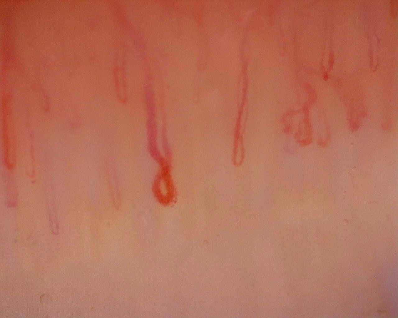 Nailfold capillaroscopy: right index finger, field a. Initial study. Juvenile Dermatomyositis anti-NXP2 with Capillaroscopic Improvement.
