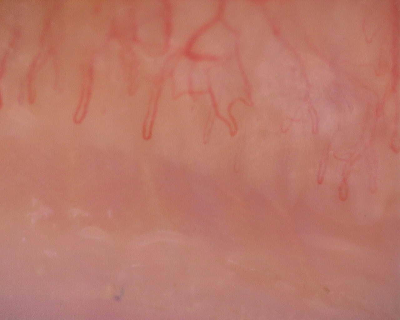 Nailfold capillaroscopy: left ring finger, field a. Initial study. Juvenile Dermatomyositis anti-NXP2 with Capillaroscopic Improvement.