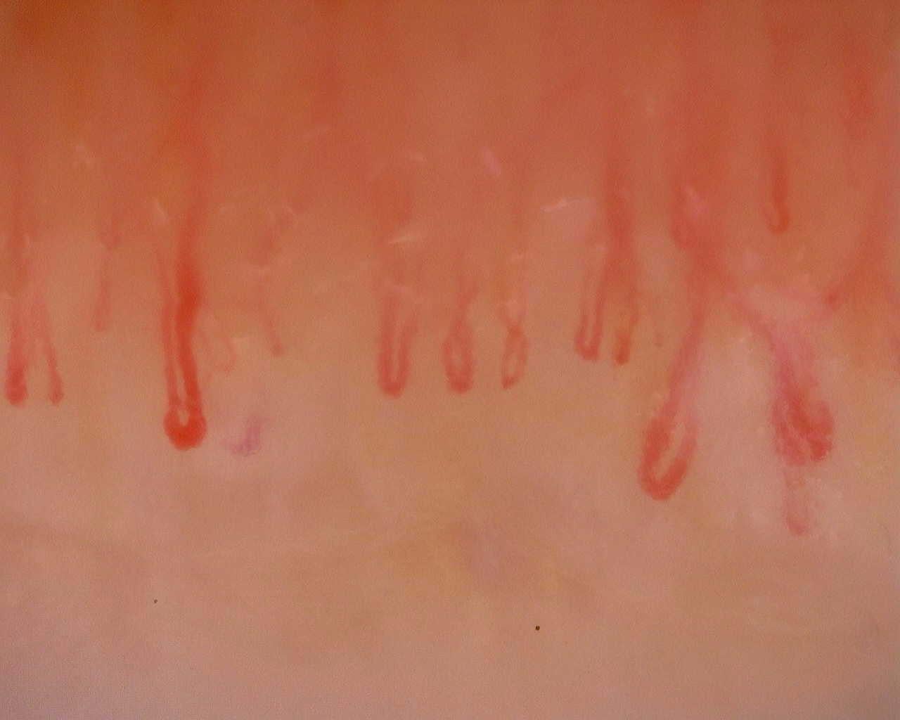 Nailfold capillaroscopy: left index finger, field a. Initial study. Juvenile Dermatomyositis anti-NXP2 with Capillaroscopic Improvement.
