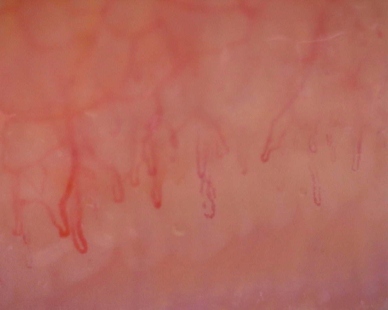 Nailfold capillaroscopy: left little finger, field a. Initial study. Juvenile Dermatomyositis anti-NXP2 with Capillaroscopic Improvement.