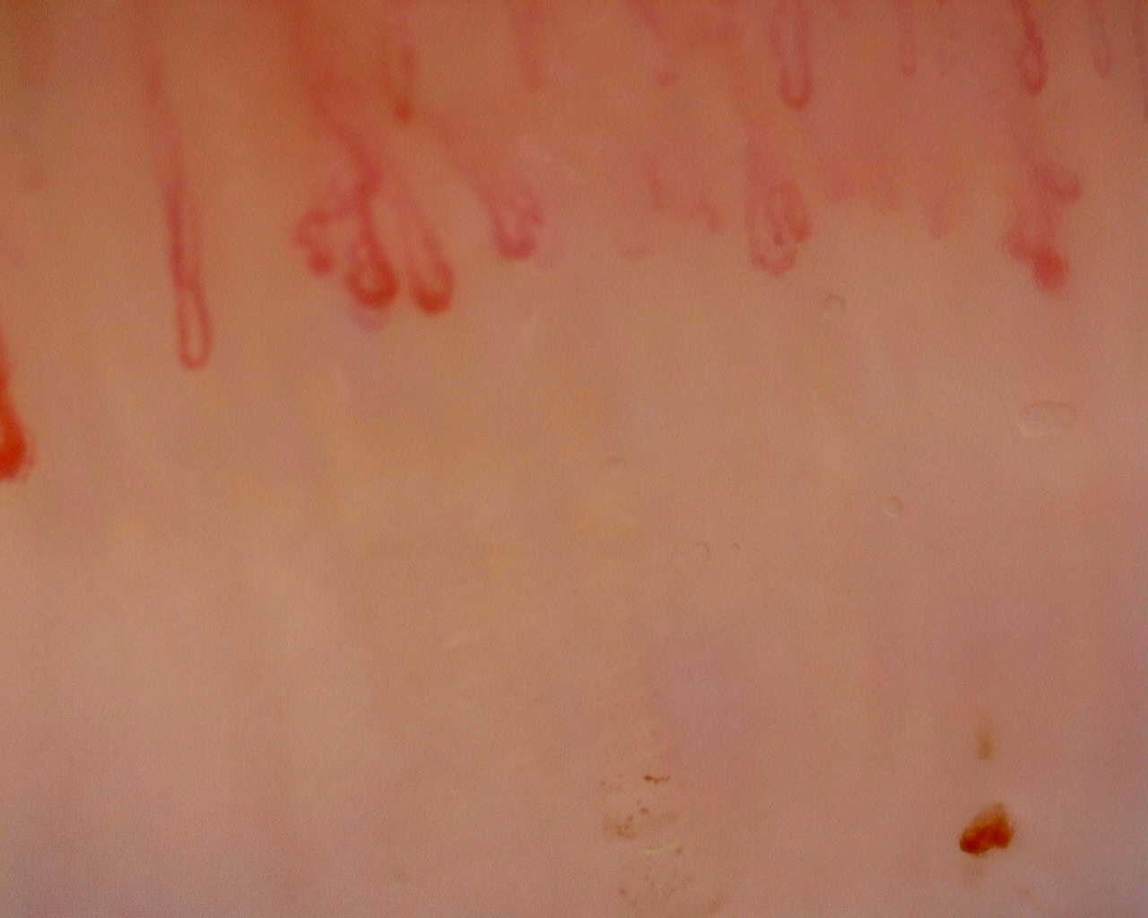 Nailfold capillaroscopy: right index finger, field a. Initial study. Juvenile Dermatomyositis anti-NXP2 with Capillaroscopic Improvement.