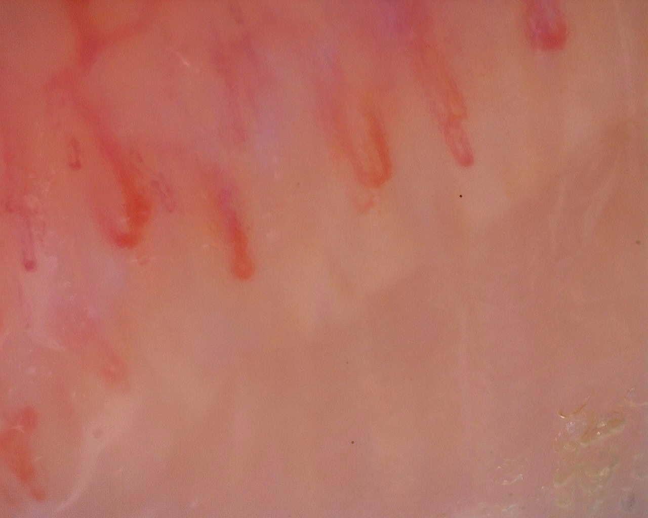 Nailfold capillaroscopy: right middle finger, field a. Initial study. Juvenile Dermatomyositis anti-NXP2 with Capillaroscopic Improvement.