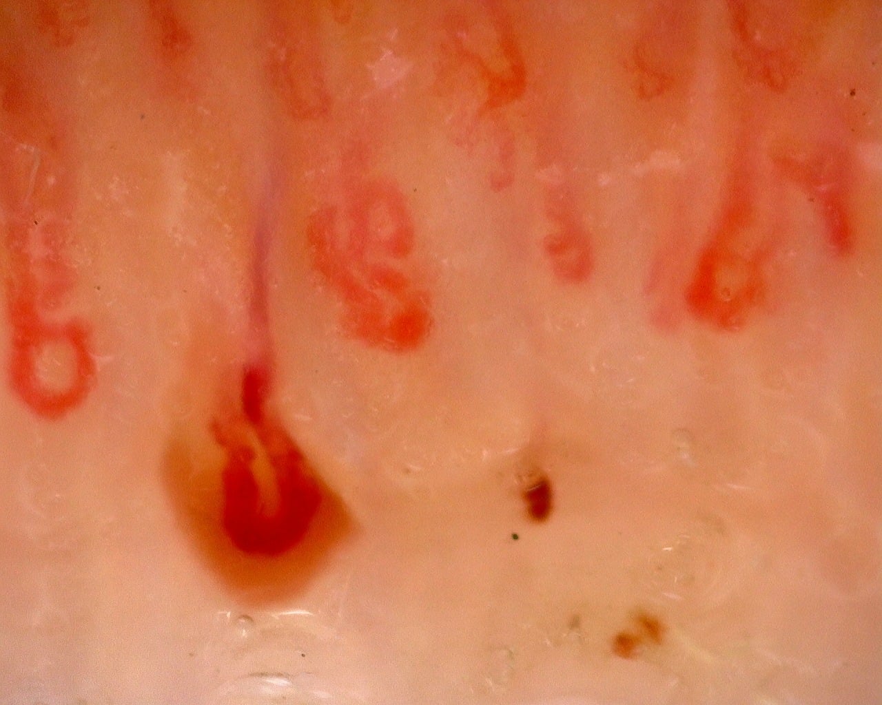 Nailfold capillaroscopy: left ring finger, field c. Juvenile Dermatomyositis with Gottron Lesions and a Scleroderma-Like Pattern.