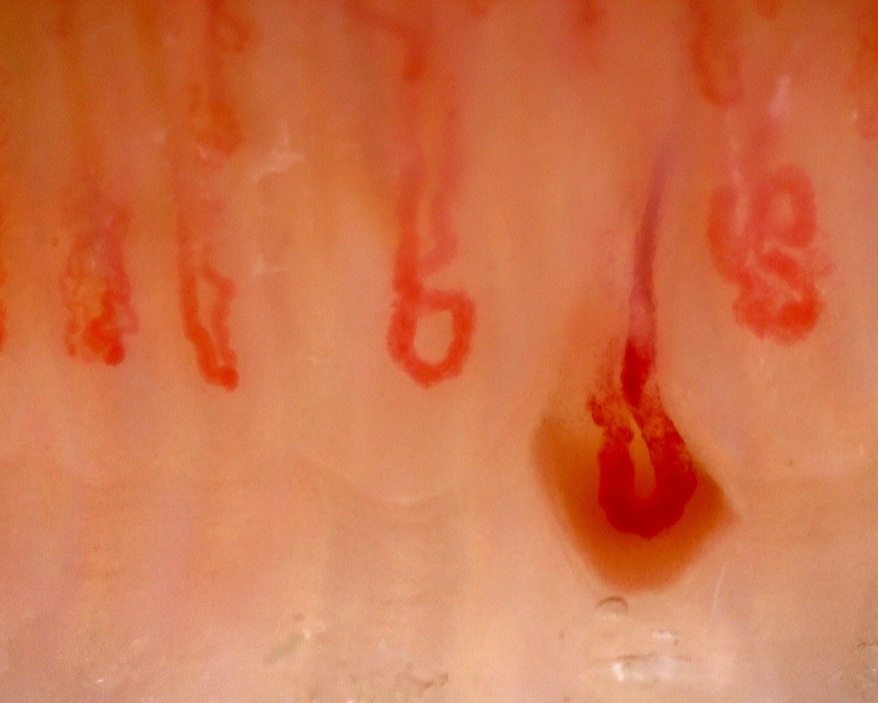 Nailfold capillaroscopy: left index finger, field c. Juvenile Dermatomyositis with Gottron Lesions and a Scleroderma-Like Pattern.