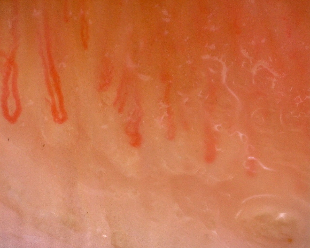 Nailfold capillaroscopy: right middle finger, field a. Juvenile Dermatomyositis with Gottron Lesions and a Scleroderma-Like Pattern.
