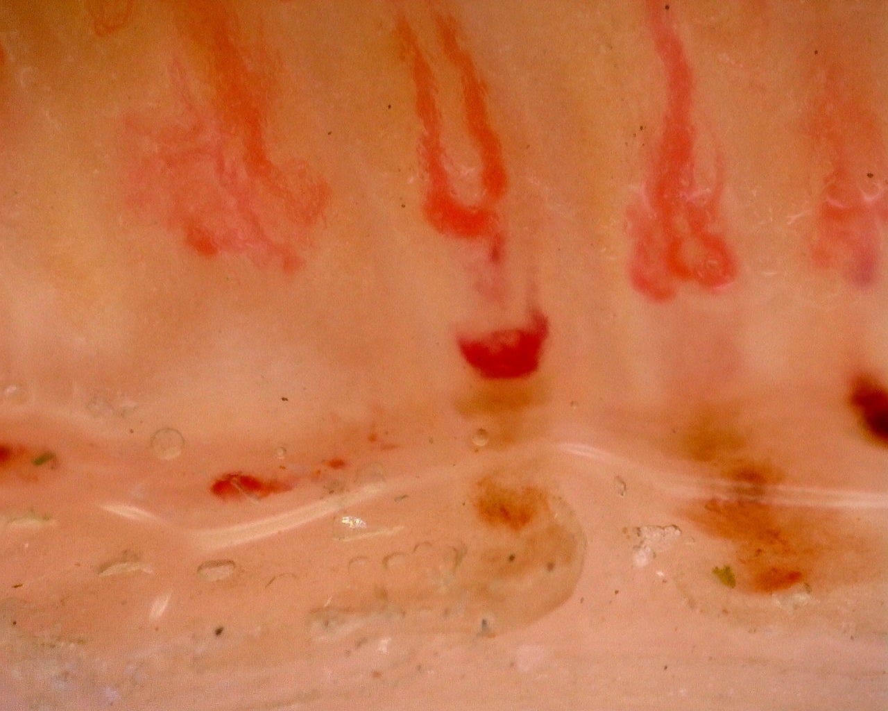Nailfold capillaroscopy: left middle finger, field c. Juvenile Dermatomyositis with Gottron Lesions and a Scleroderma-Like Pattern.