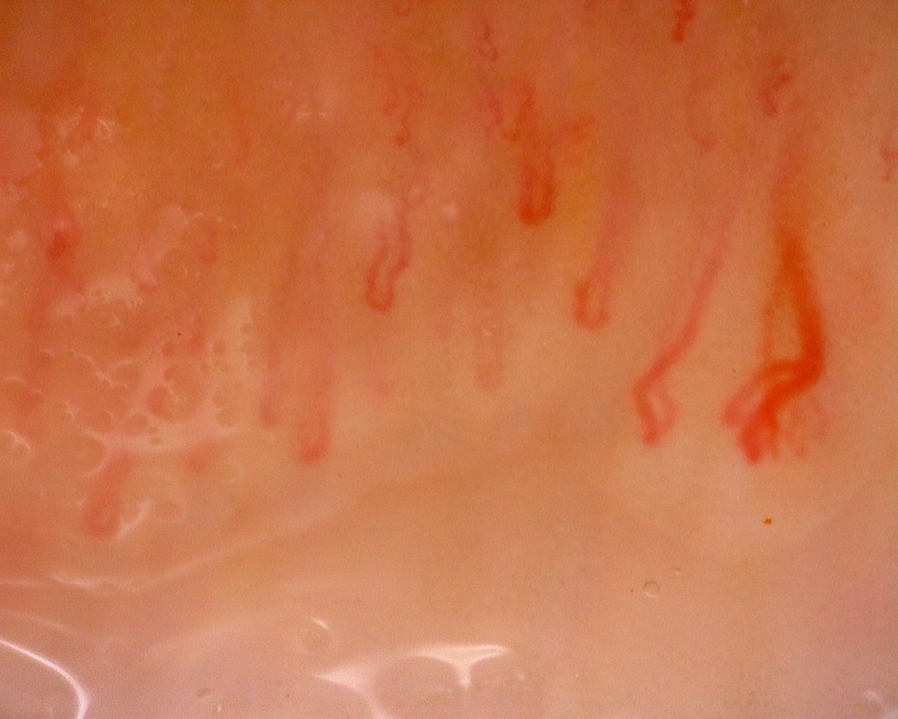 Nailfold capillaroscopy: left index finger, field d. Juvenile Dermatomyositis with Gottron Lesions and a Scleroderma-Like Pattern.