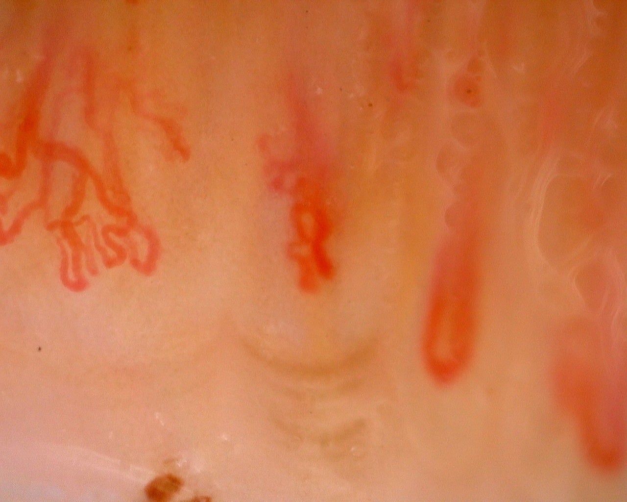 Nailfold capillaroscopy: right ring finger, field a. Juvenile Dermatomyositis with Gottron Lesions and a Scleroderma-Like Pattern.