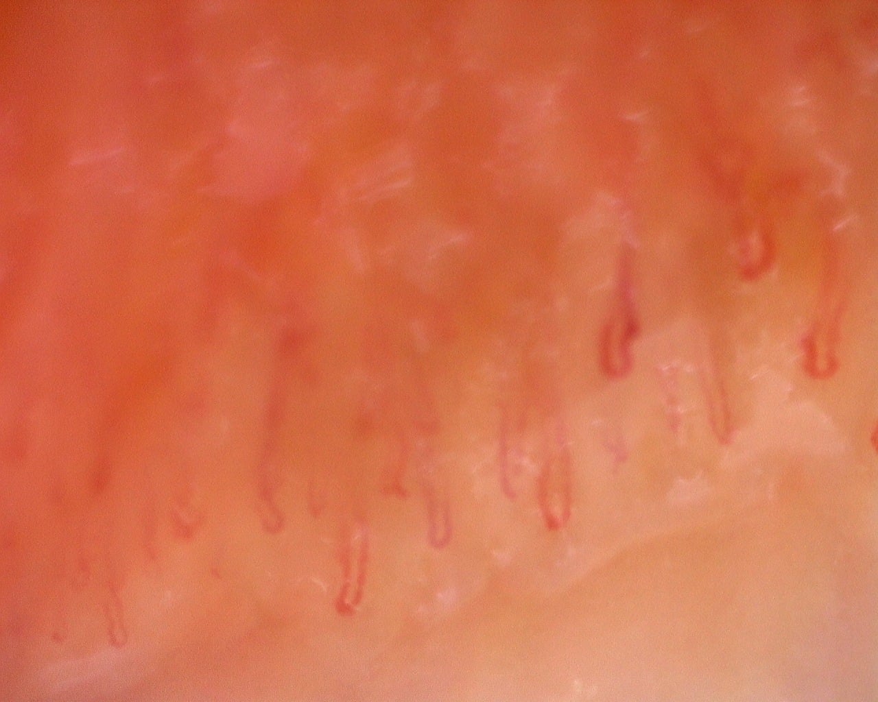 Nailfold capillaroscopy: left ring finger, field d. Juvenile Dermatomyositis with Gottron Lesions and a Scleroderma-Like Pattern.