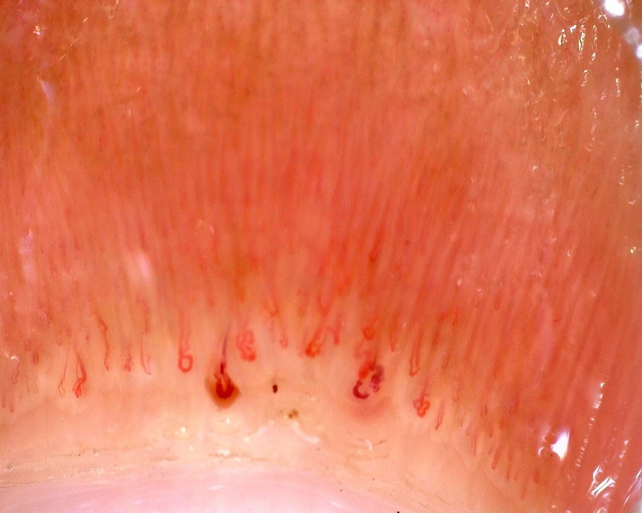 Nailfold overview from the juvenile dermatomyositis case with Gottron papules. The complete report describes the vascular abnormalities; this image is an orientation view.