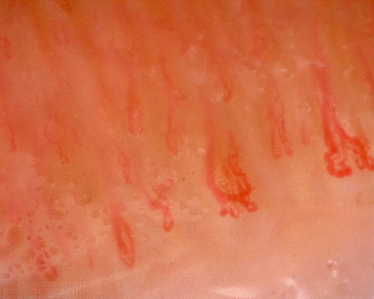 Nailfold capillaroscopy: left middle finger, field d. Juvenile Dermatomyositis with Gottron Lesions and a Scleroderma-Like Pattern.