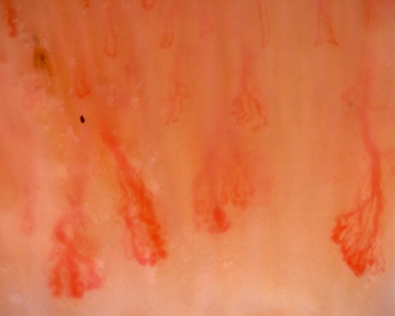 Nailfold capillaroscopy: right little finger, field c. Juvenile Dermatomyositis with Gottron Lesions and a Scleroderma-Like Pattern.